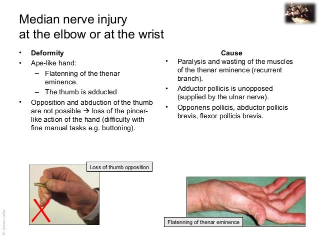 median nerve thumb Sexy detective magizine